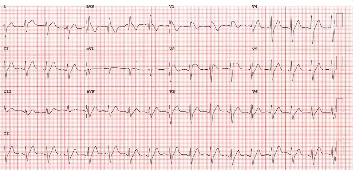 non specific qrs widening ivcd
